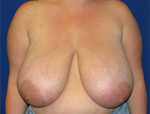 Patient # 72127 Before Photo # 1