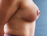 Patient # 54188 After Photo # 4