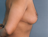 Patient # 23263 After Photo # 4