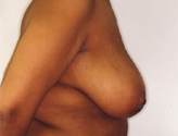 Patient # 23263 Before Photo # 3