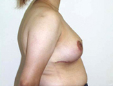 Patient # 89686 After Photo # 4