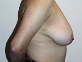 Patient # 89686 Before Photo # 3