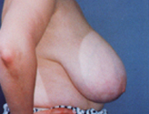 Patient # 74660 Before Photo # 3