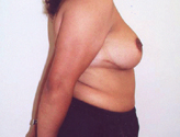 Patient # 55601 After Photo # 4