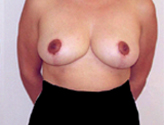 Patient # 43656 After Photo # 2