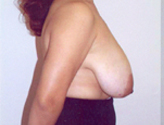 Patient # 43656 Before Photo # 3