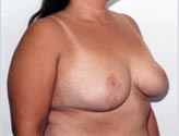 Patient # 60515 After Photo # 2