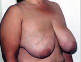 Patient # 60515 Before Photo # 1