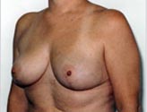 Patient # 91516 After Photo # 2