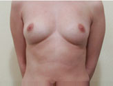 Patient # 73753 Before Photo # 1