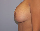 Patient # 79818 After Photo # 6