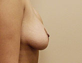Patient # 79818 Before Photo # 3