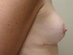 Patient # 14849 After Photo # 8
