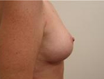 Patient # 15295 After Photo # 4
