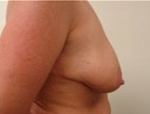 Patient # 15295 Before Photo # 3