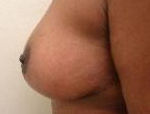 Patient # 68230 After Photo # 2
