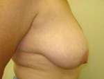Patient # 32431 Before Photo # 1