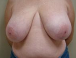 Patient # 50763 Before Photo # 1