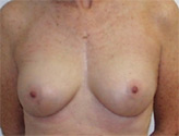Patient # 72607 After Photo # 2
