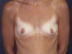 Patient # 27738 Before Photo # 1