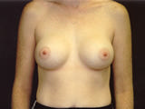 Patient # 30079 After Photo # 2
