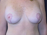 Patient # 51527 After Photo # 2