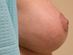 Patient # 75327 After Photo # 4