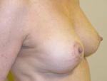 Patient # 78952 After Photo # 2