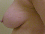 Patient # 78952 Before Photo # 3