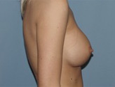 Patient # 82759 After Photo # 4