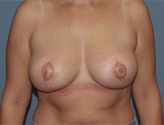 Patient # 87317 After Photo # 2
