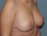 Patient # 87317 After Photo # 4