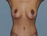Patient # 96662 After Photo # 2