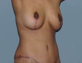 Patient # 96662 After Photo # 4