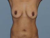 Patient # 96662 Before Photo # 1