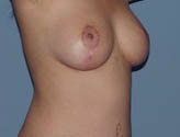 Patient # 58805 After Photo # 4