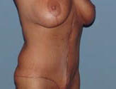 Patient # 31350 After Photo # 2