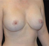 Patient # 22772 After Photo # 2