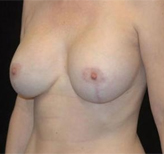 Patient # 22772 After Photo # 4