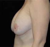 Patient # 22772 Before Photo # 3