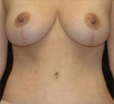 Patient # 68149 After Photo # 2