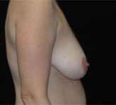 Patient # 68149 Before Photo # 5