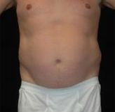 Patient # 13043 Before Photo # 1