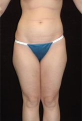 Patient # 30314 Before Photo # 1