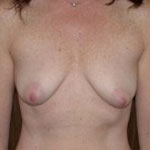 Patient # 38825 Before Photo # 1