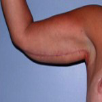 Patient # 36852 After Photo # 4