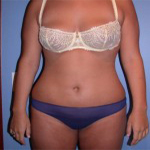 Patient # 82754 After Photo # 2