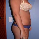Patient # 82754 After Photo # 4