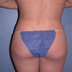 Patient # 82754 After Photo # 8