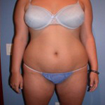 Patient # 82754 Before Photo # 1